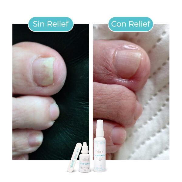 COMBO UÑAS Y PIES: Tratamiento para hongos en uñas y pies - Imagen 2