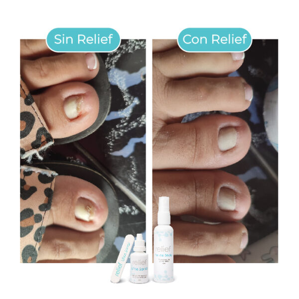 COMBO UÑAS Y PIES: Tratamiento para hongos en uñas y pies - Imagen 4