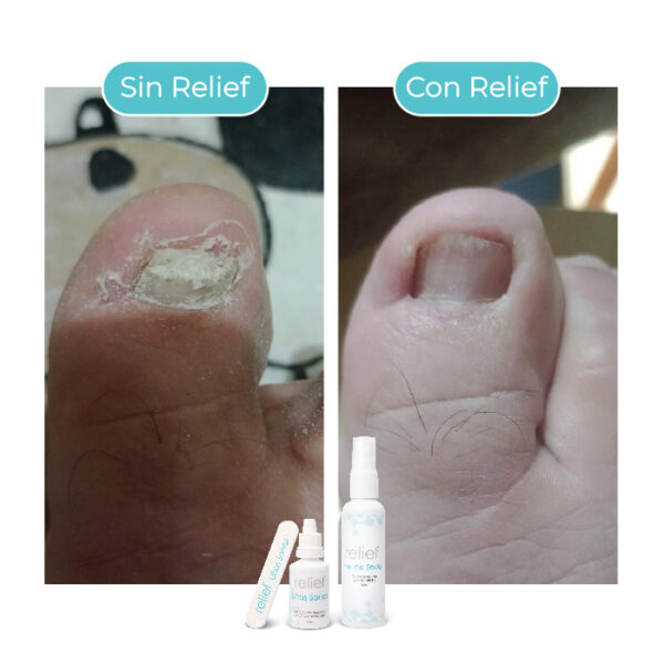 COMBO UÑAS Y PIES: Tratamiento para hongos en uñas y pies - Imagen 6