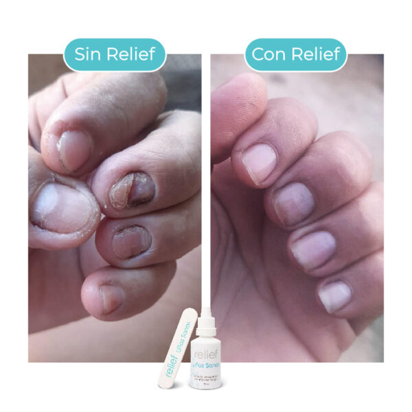 UÑAS SANAS: Gotas para hongos en las uñas - Imagen 2