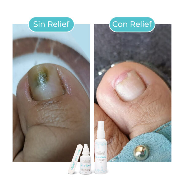 UÑAS SANAS: Gotas para hongos en las uñas - Imagen 3