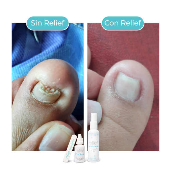 UÑAS SANAS: Gotas para hongos en las uñas - Imagen 4