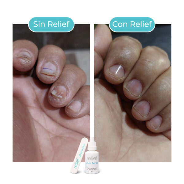 UÑAS SANAS: Gotas para hongos en las uñas - Imagen 5