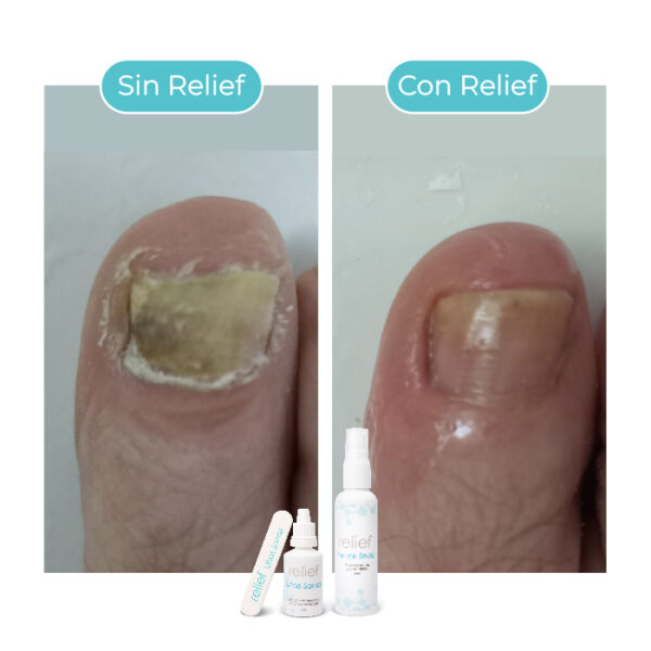 UÑAS SANAS: Gotas para hongos en las uñas - Imagen 6