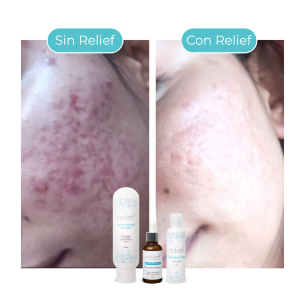 KIT ANTIACNÉ: Gel limpiador, despigmentante y protector solar - Imagen 2