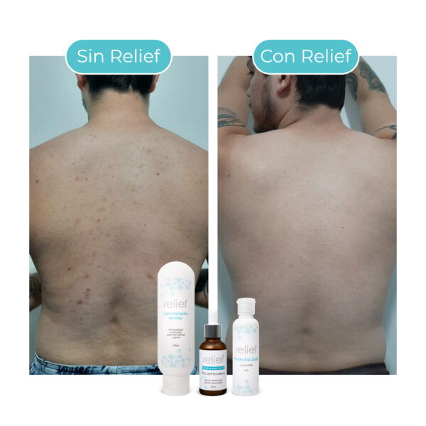 KIT ANTIACNÉ: Gel limpiador, despigmentante y protector solar - Imagen 3